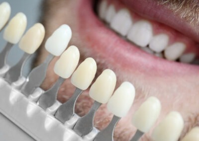 Porcelain Veneers