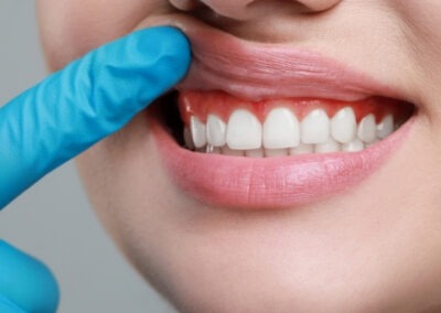 Gum Grafts