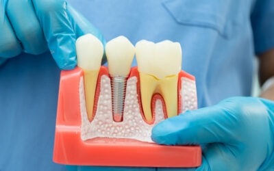Root Canal