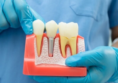Root Canal