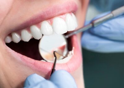 Full Mouth Rehabilitation